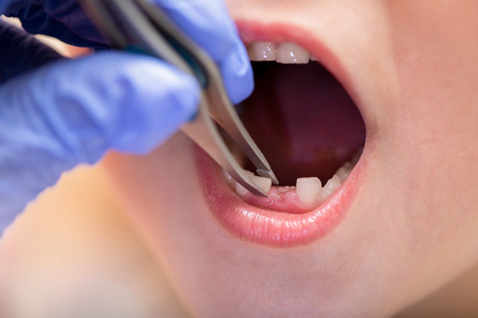 Does my child really need healthy teeth pulled